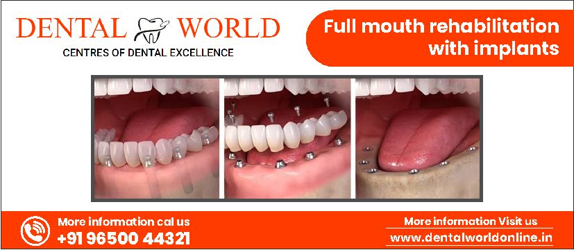 Full Mouth Rehabilitation With Implants