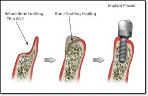 Bone Graft with dental implant