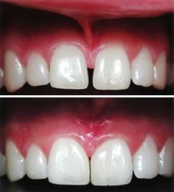 Frenectomy before and after photo