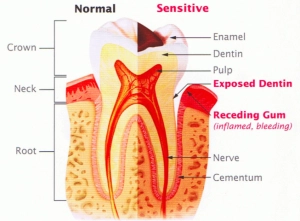 Sensitive Teeth Diagram