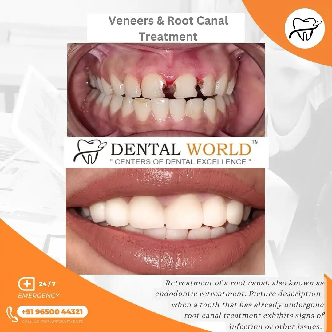 Root Canal Treatment Testimonial By Dental World