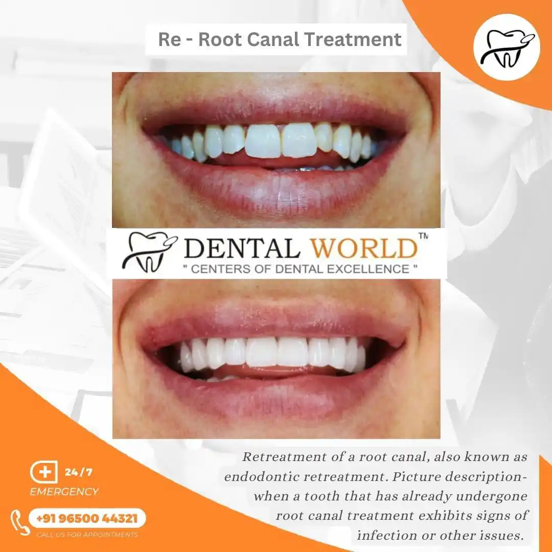 Root Canal Treatment Testimonial By Dental World