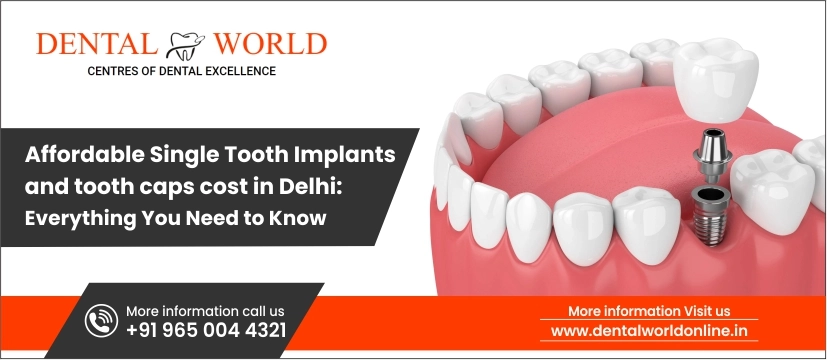Single tooth implants and tooth cap cost in Delhi
