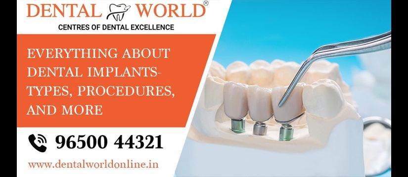 Everything about Dental Implants
