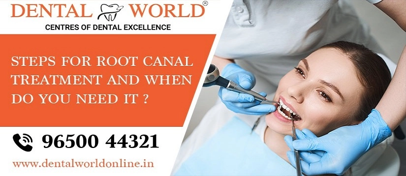 Steps for Root Canal Treatment
