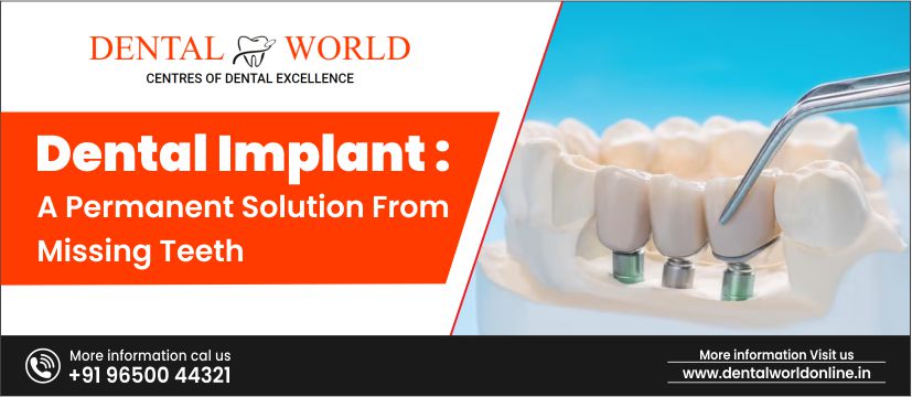 Dental Implant- Permanent Solution For Missing Teeth