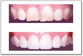 Cosmetic Dentistry In Delhi- Before & After