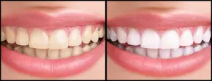 Dental Bleaching In Delhi- Before & After